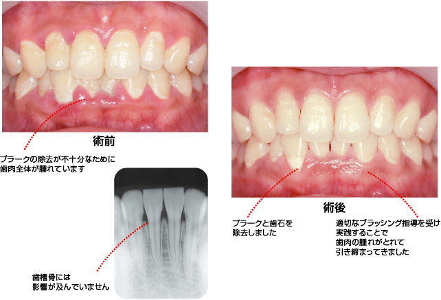 歯肉炎の処置例