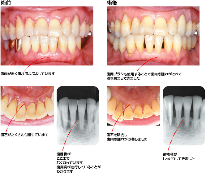 中等度歯周炎の処置例